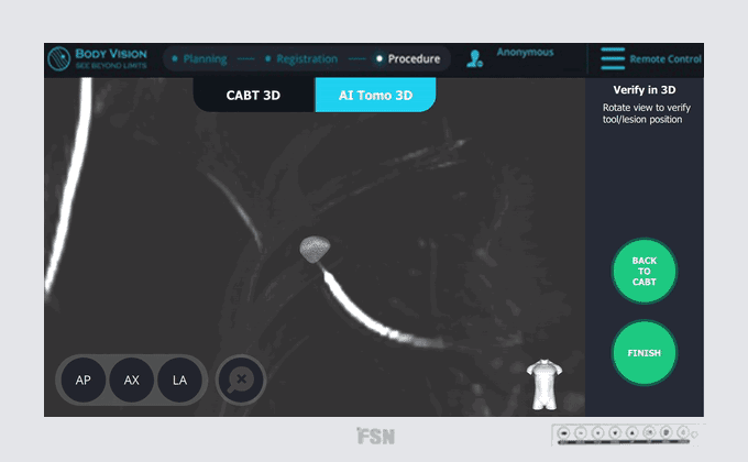 Real-Time, Tool-In-Lesion Confirmation: Inside the Body Vision Process Real-Time, Tool-In-Lesion Confirmation: Inside the Body Vision Process